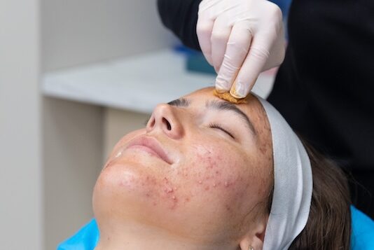 A provider applies a patient's chemical peel, a treatment often used to enhance the effects of Morpheus8 in Bethesda, MD.