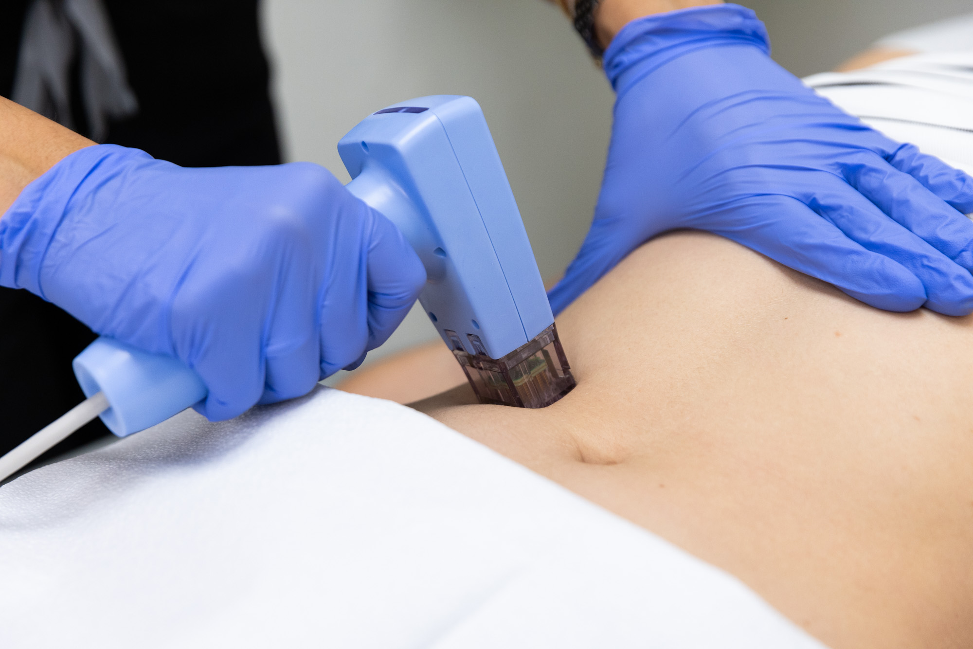 Dr. Faulkner applies the Morpheus Body handpiece to a patient's abdomen in a treatment similar to Morpheus8 in Bethesda.